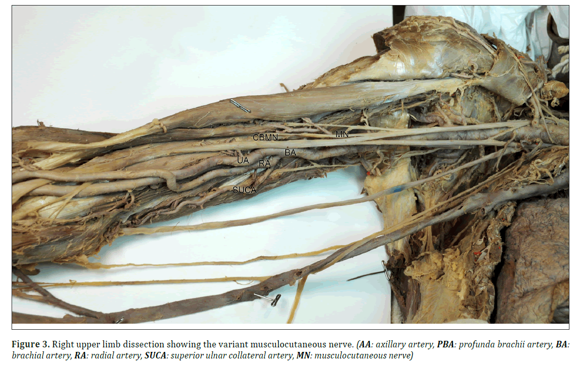 anatomical-variations-variant-musculocutaneous