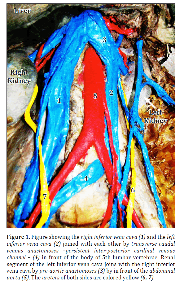 anatomical-variations-vena-cava
