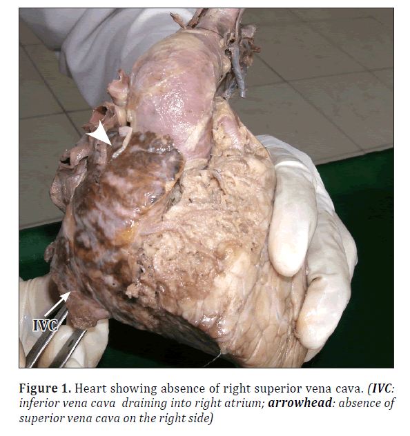 anatomical-variations-vena-cava