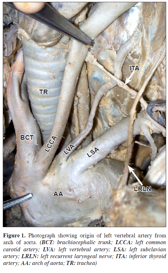 anatomical-variations-vertebral-artery