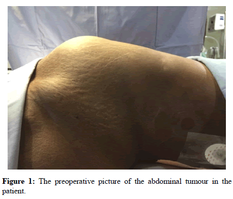 anesthesiology-abdominal-tumour