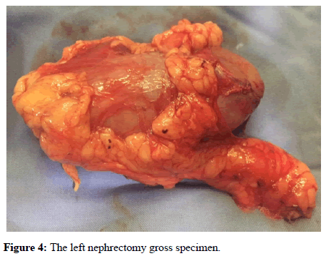 anesthesiology-left-nephrectomy