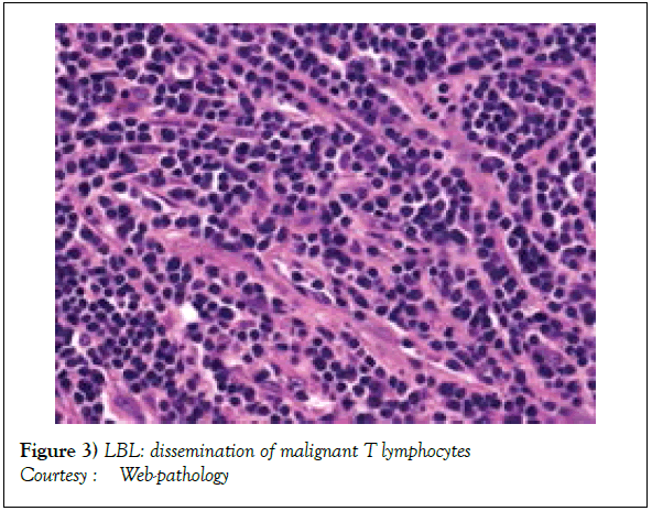 blood-disorders-treatment-malignant