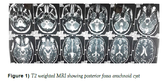 child-adolescent-psychiatry-arachnoid-cyst