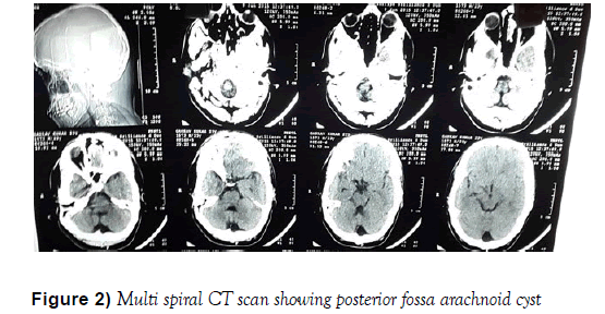 child-adolescent-psychiatry-posterior-fossa