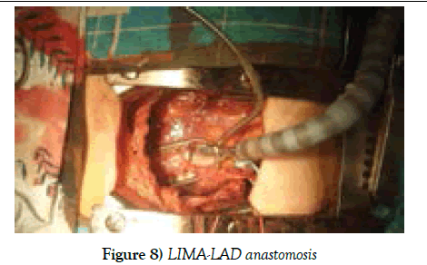 clinical-cardiology-LIMA-LAD