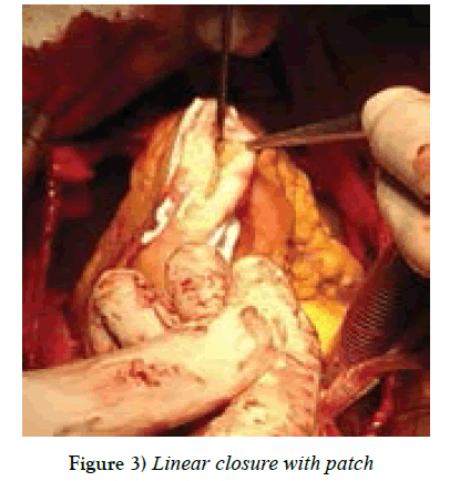 clinical-cardiology-Linear-closure