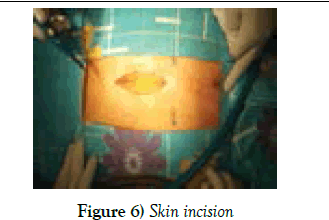 clinical-cardiology-Skin-incision
