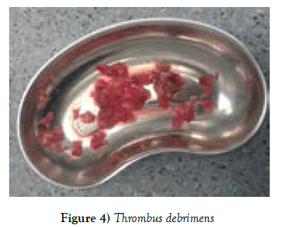 clinical-cardiology-Thrombus-debrimens