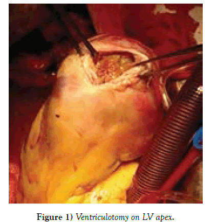 clinical-cardiology-Ventriculotomy