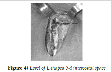 clinical-cardiology-intercostal-space