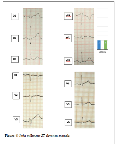 clinical-cardiology-journal-elevation