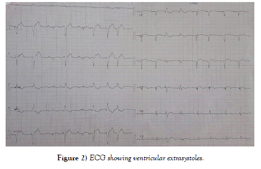 clinical-cardiology-journal-extrasystoles