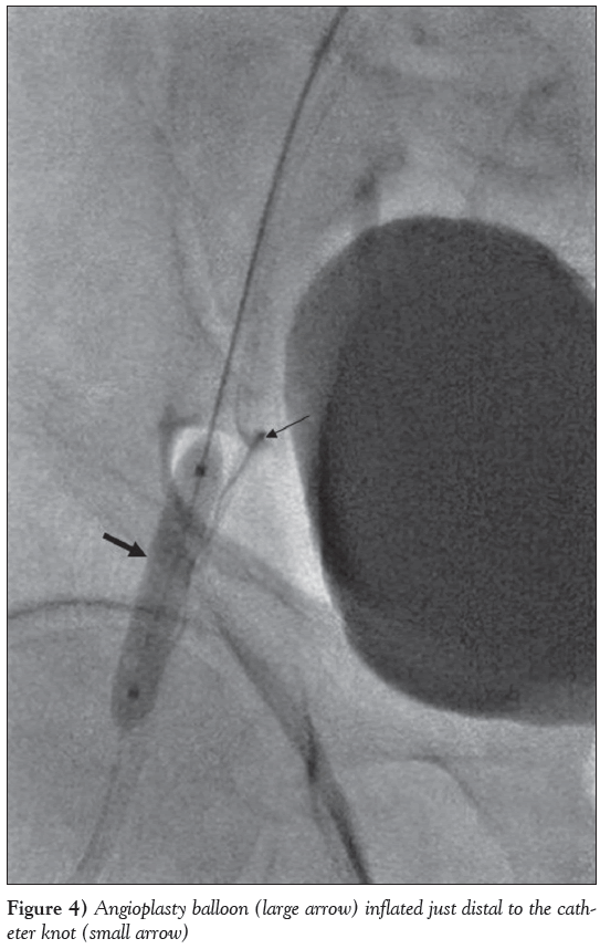 current-research-cardiology-Angioplasty-balloon