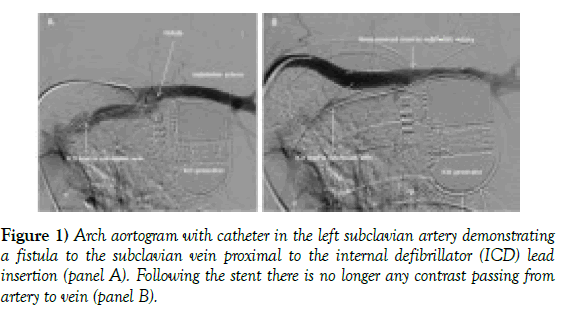 current-research-cardiology-Arch-aortogram