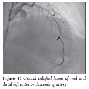 current-research-cardiology-Critical-calcified
