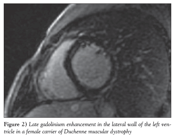 current-research-cardiology-Duchenne-muscular