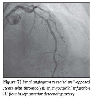 current-research-cardiology-Final-angiogram