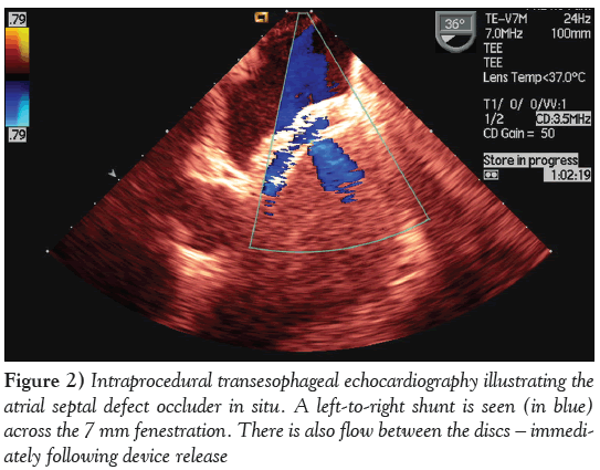 current-research-cardiology-Intraprocedural-transesophageal