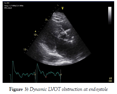 current-research-cardiology-LVOT-obstruction