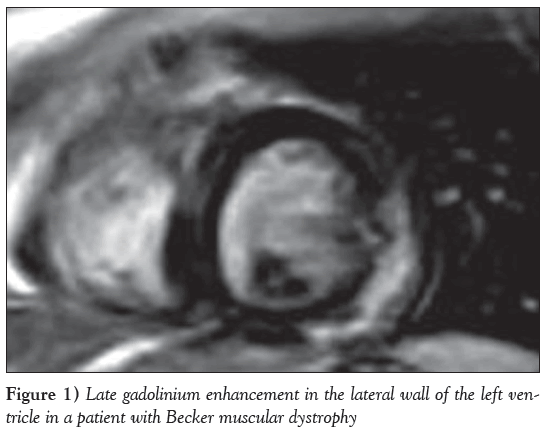 current-research-cardiology-Late-gadolinium