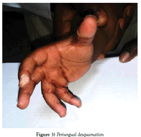 current-research-cardiology-Periungual-desquamation