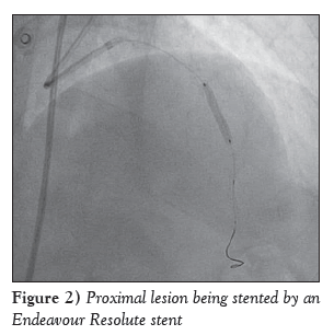 current-research-cardiology-Proximal-lesion