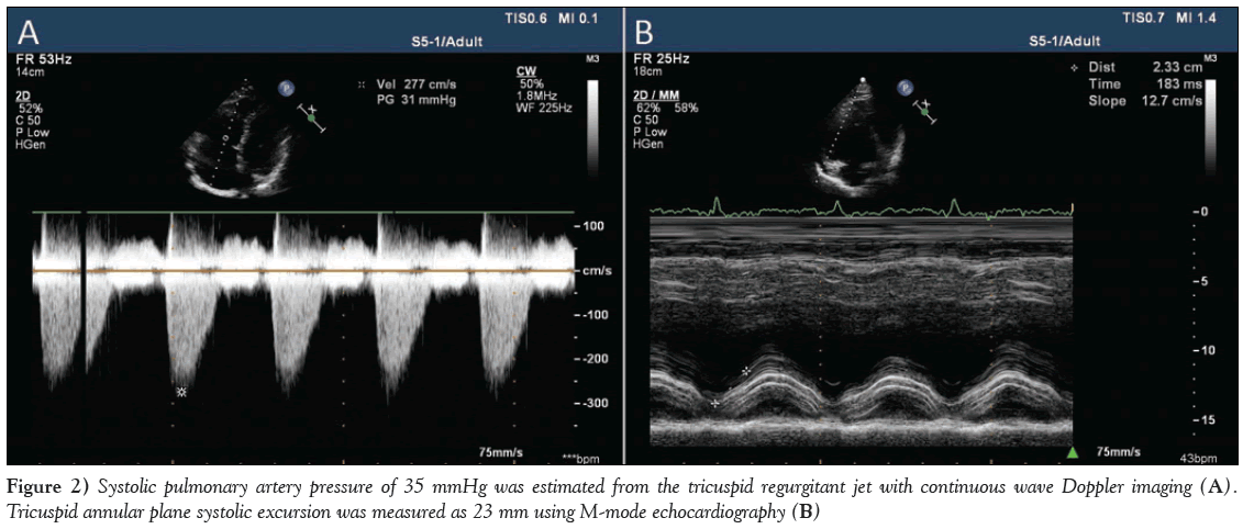 current-research-cardiology-Systolic-pulmonary