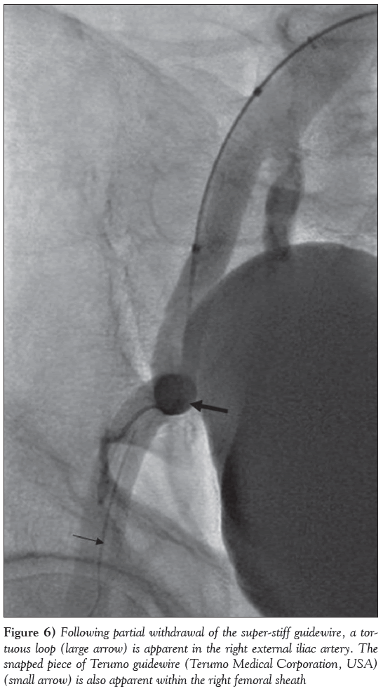 current-research-cardiology-Terumo-guidewire