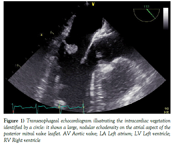 current-research-cardiology-Transesophageal-echocardiogram