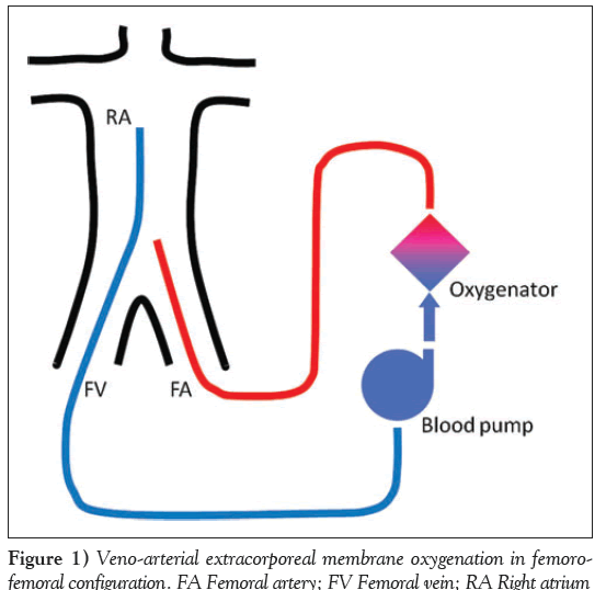 current-research-cardiology-Veno-arterial-extracorporeal