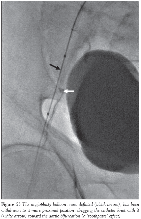 current-research-cardiology-angioplasty-balloon