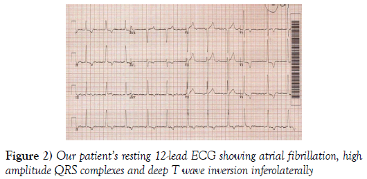 current-research-cardiology-atrial-fibrillation