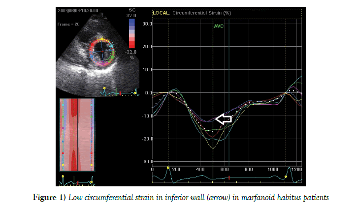 current-research-cardiology-circumferential-strain