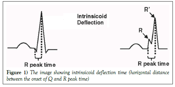 current-research-cardiology-deflection-time