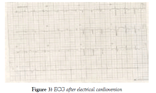 current-research-cardiology-electrical-cardioversion