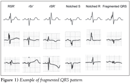 current-research-cardiology-fragmented-QRS-pattern