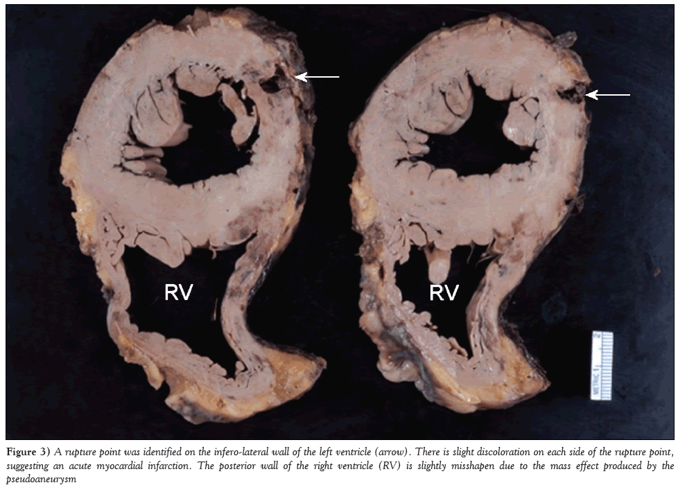 current-research-cardiology-infero-lateral