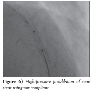 current-research-cardiology-postdilation