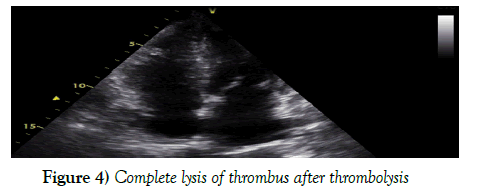 current-research-cardiology-thrombolysis