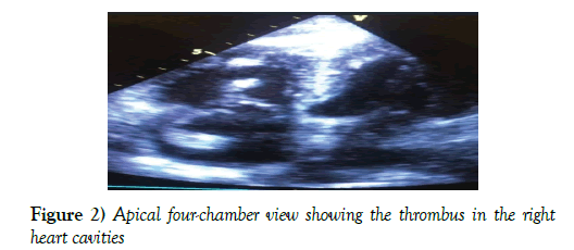 current-research-cardiology-thrombus