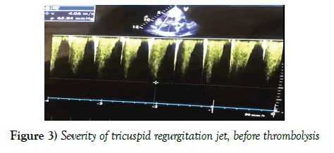 current-research-cardiology-tricuspid