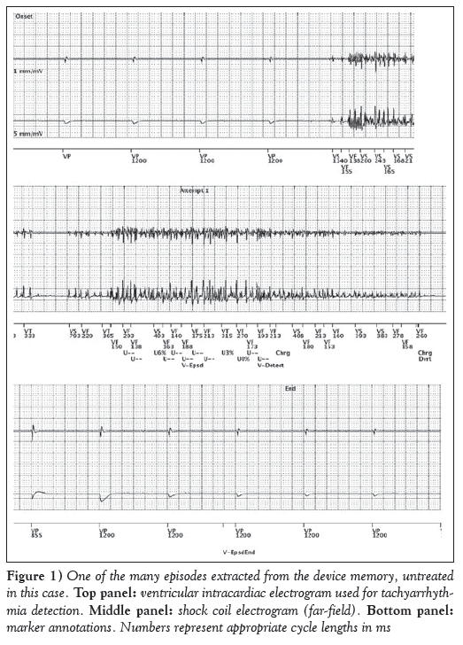 current-research-cardiology-ventricular-intracardiac-electrogram