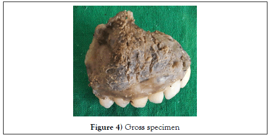 dental-oral-Gross-specimen