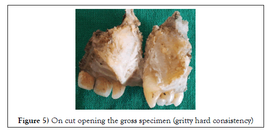 dental-oral-gritty-hard-consistency