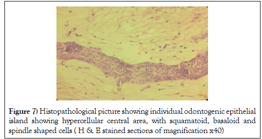 dental-oral-squamatoid