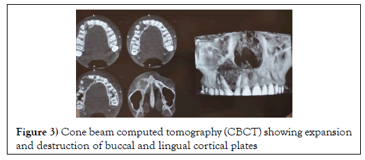 dental-oral-radiolucency