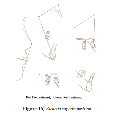 dentistry-Ricketts-superimposition