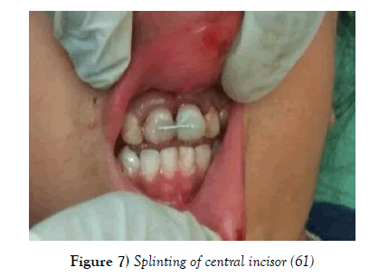 dentistry-Splinting