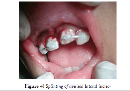dentistry-Splinting-avulsed